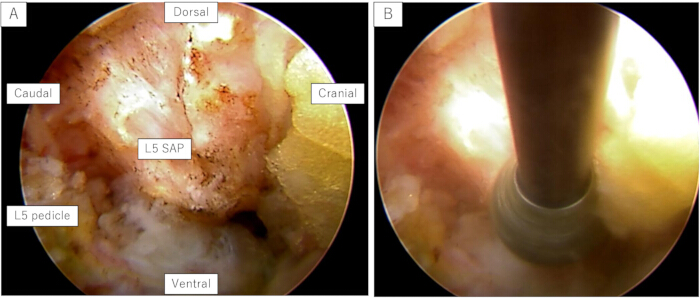 figure-results-3 Endoscopic view of L5 SAP and pedicle, labeled regions for spinal anatomy study.