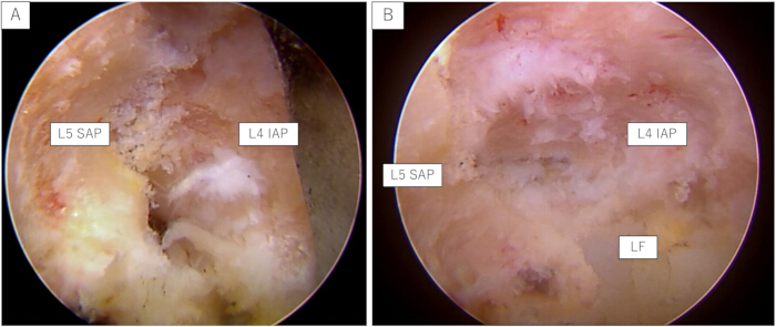figure-results-4 Microscope images, spinal anatomy, labeled L5 SAP, L4 IAP, LF, educational medical reference.