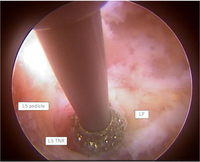 figure-results-5 Endoscopic view of L5 spinal anatomy, highlighting pedicle, TNR, and LF. Medical examination.