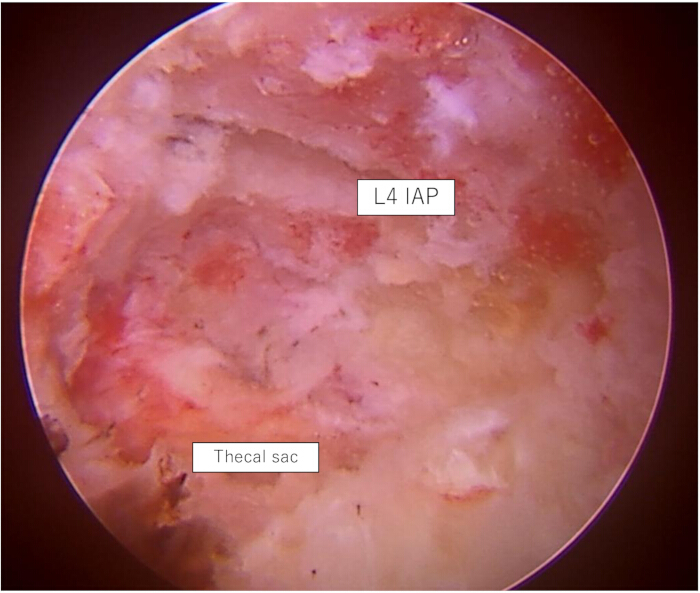 figure-results-6 L4 IAP thecal sac in endoscopic image, highlighting anatomical structures, spine diagnostics.