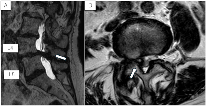 figure-results-7 MRI of lumbar spine showing herniated disc between L4-L5; sagittal and axial views for diagnosis.
