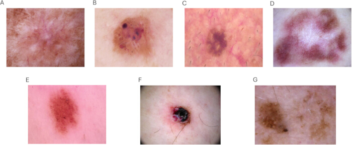 figure-protocol-2 Skin lesion examples, dermoscopy method, clinical dermatology diagnosis, image analysis.
