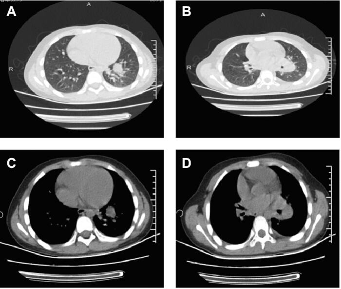 CT scan comparison, lungs and chest sections; medical imaging analysis.