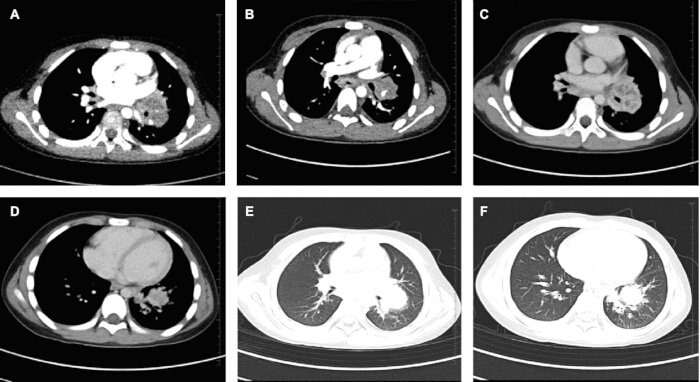 CT scan series; axial thoracic analysis; medical imaging; lung and heart assessment; radiology.