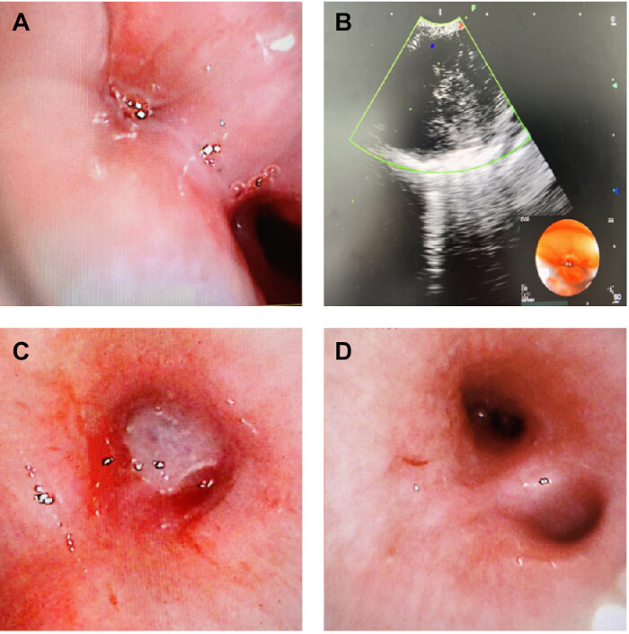 Endoscopic ultrasound and imaging; gastric lesion diagnosis and analysis.