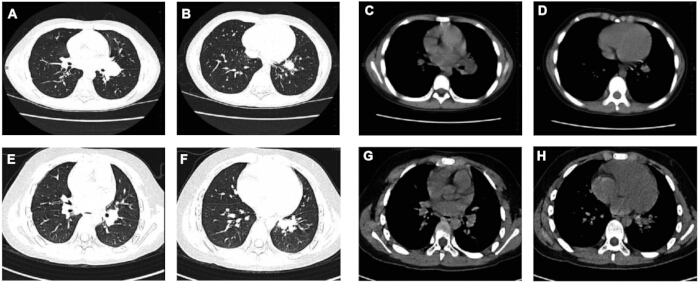 CT scans of thoracic cross-sections, showing lung and heart images; diagnostic imaging analysis.