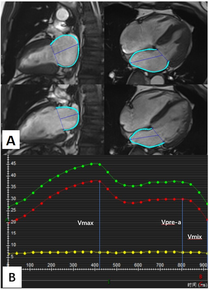 Cardiac MRI analysis; segmented heart contours; velocity-time graph; hemodynamic assessment.