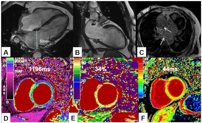 Cardiac MRI with quantitative data maps; T1 relaxation, ECV index, T2 mapping; heart analysis.