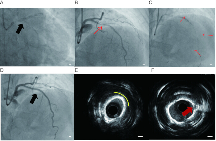 figure-results-3 Coronary angiography and intravascular ultrasound images showing artery blockage and stent placement.