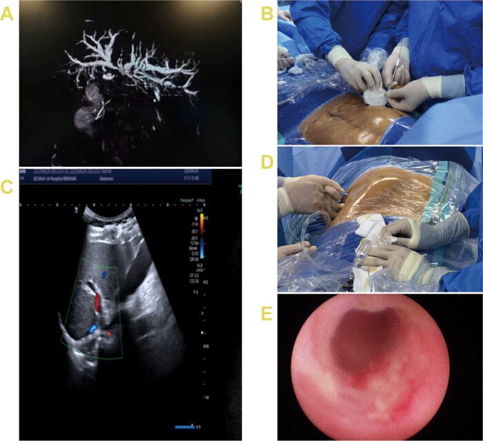 A. Angiography scan showing vascular network, medical imaging analysis.

B. Surgical preparation in sterile environment, medical procedure.

C. Doppler ultrasound with blood flow measurement, diagnostic imaging.

D. Medical team performing surgery, sterile technique.

E. Endoscopic view of tissue, internal examination.
