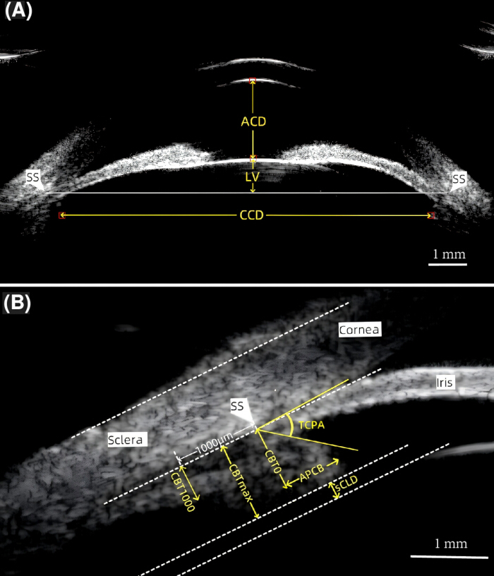OCT eye diagrams showing anterior chamber depth and corneal angles; optical measurement analysis.