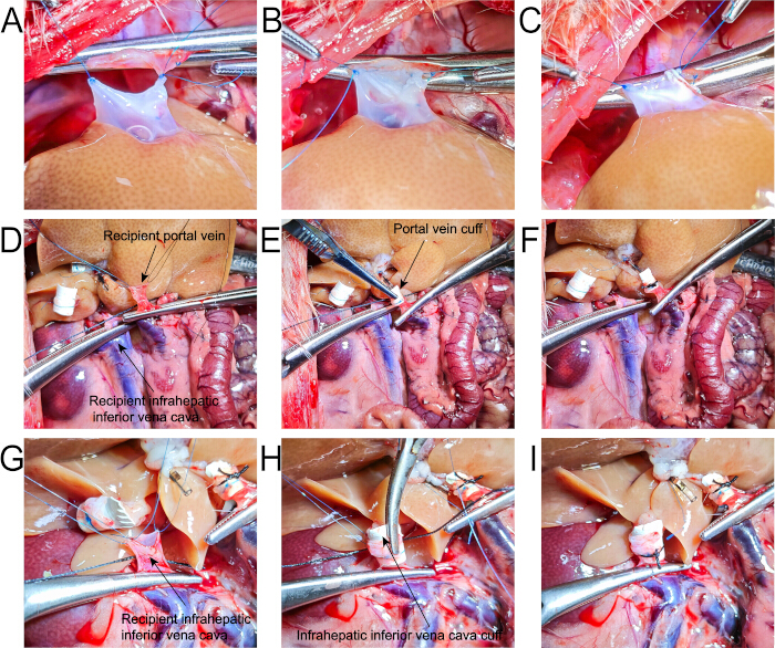 figure-protocol-6 Surgical procedure on portal vein and vena cava; step-by-step sequence; transplantation method.