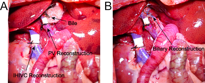 figure-protocol-7 Hepatic surgery diagram showing IHIVC, PV, biliary reconstruction process and bile flow reconstruction.