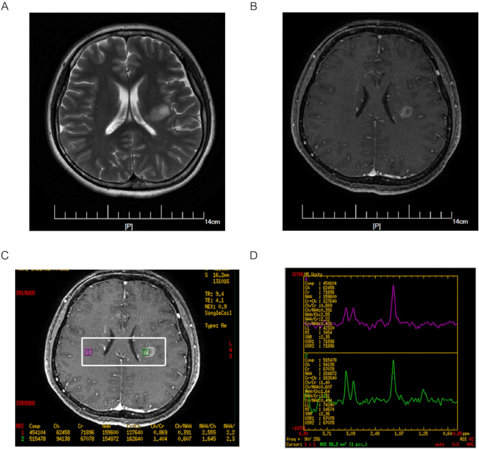 figure-results-3 Brain MRI results with spectroscopy data illustrating metabolite levels; medical imaging study.