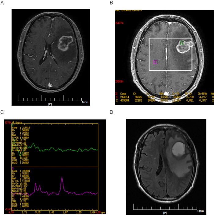 figure-results-4 MRI brain images and spectroscopy graph, analyzing tumor presence and spectral data comparison.