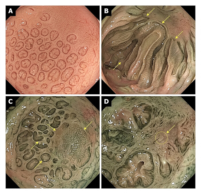 Colon tissue histology, endoscopic images A-D showing different mucosal patterns, diagnostic analysis.
