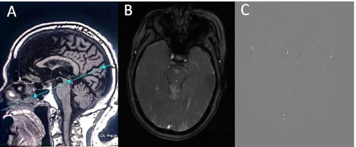 figure-protocol-1 Brain MRI scan comparison; sagittal, axial view, neurological imaging analysis.