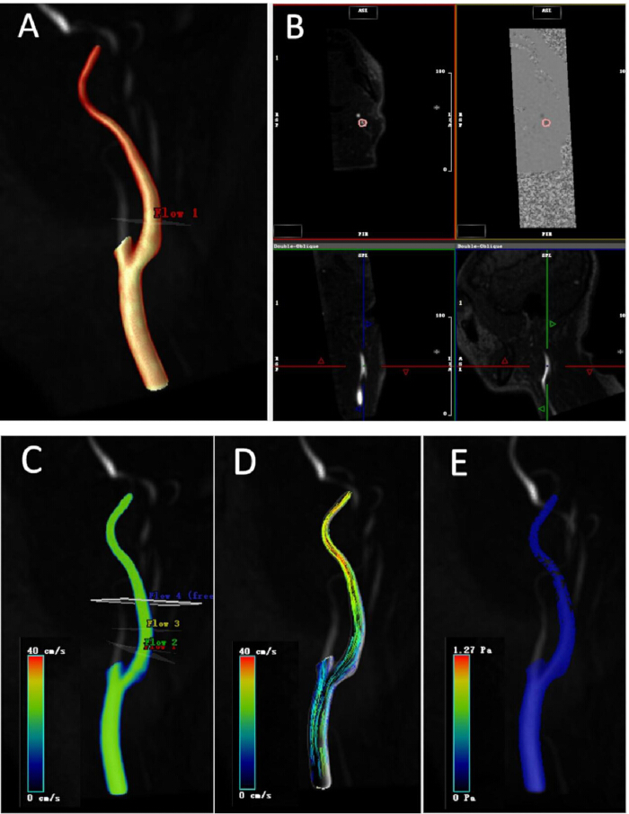 figure-protocol-3 Vascular flow analysis; diagrams A-E: blood flow velocity, MRI slices; hemodynamic study results.