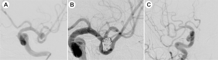 figure-results-3 Cerebral angiogram sequence showing aneurysm treatment progression, image A to C, diagnostic imaging.