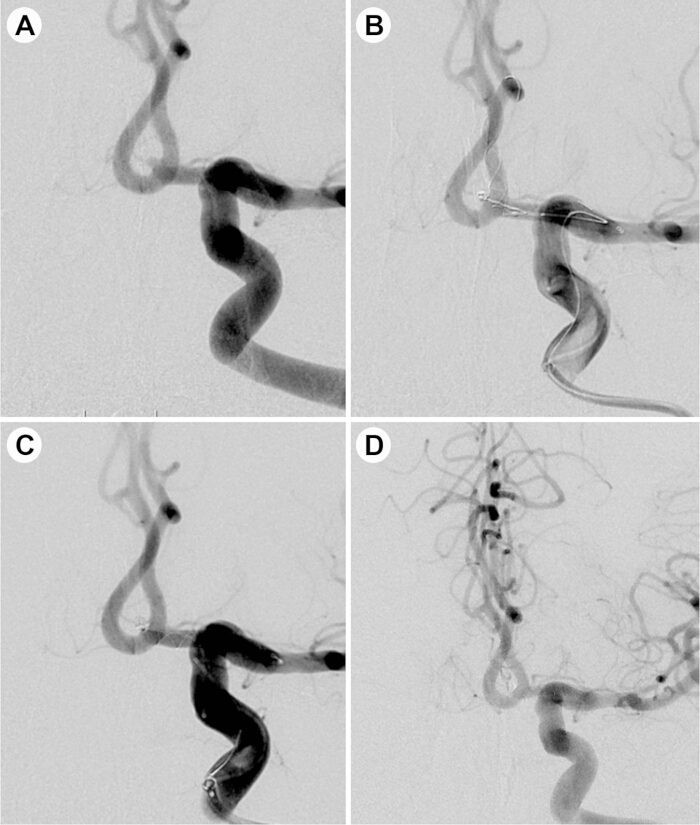 figure-results-4 Cerebral angiography sequence; vascular structure visualization; medical imaging technique.