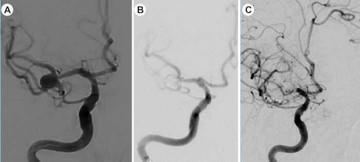 figure-results-5 Cerebral angiography images: aneurysm visualization, treatment coil placement, post-treatment flow.