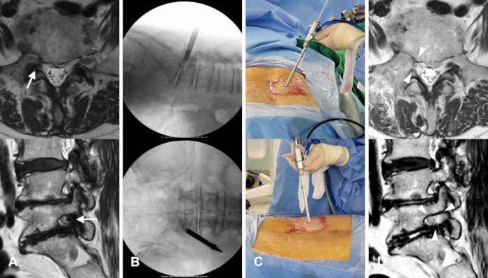 figure-protocol-1 脊柱手术过程;MRI 和透视图像;腰椎间盘切除术设备;医学分析。