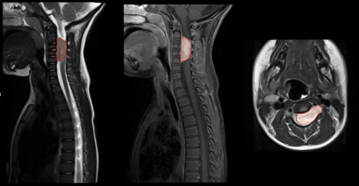 MRI scans with highlighted spinal masses; diagnostic imaging, transverse and sagittal views.