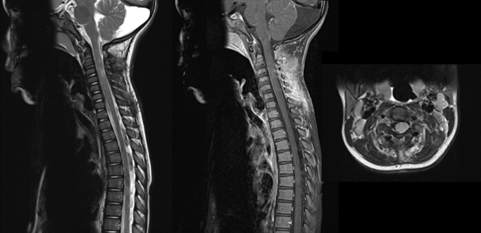 MRI scan of cervical spine; sagittal and axial views; medical imaging; spinal cord analysis.