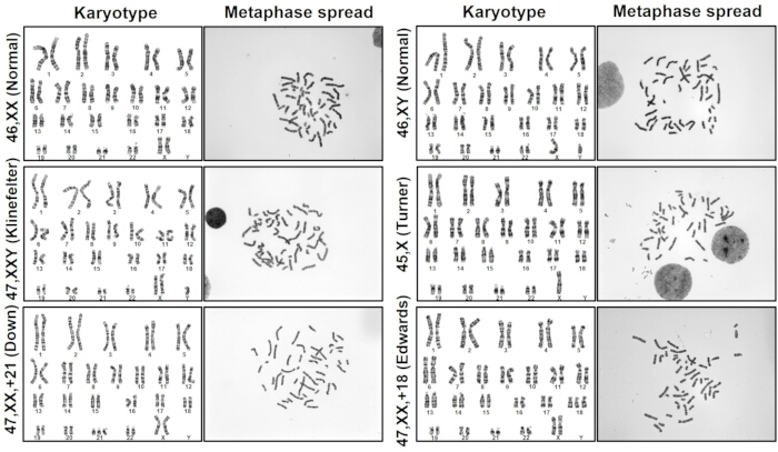 figure-results-4 Human karyotype and metaphase spread diagram; various chromosomal abnormalities.