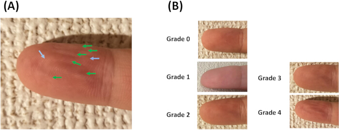 figure-results-2 Finger skin analysis diagram showing hydration levels; image (A) shows arrows for moisture detection.