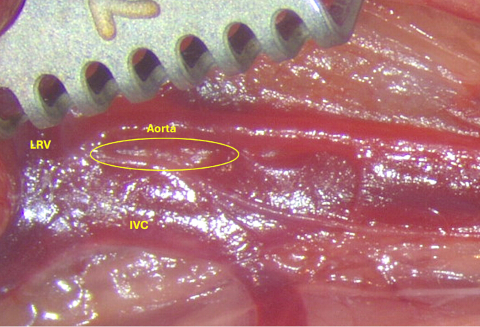 Dissection diagram of abdominal aorta, IVC, LRV; labeled vessels in vascular study.