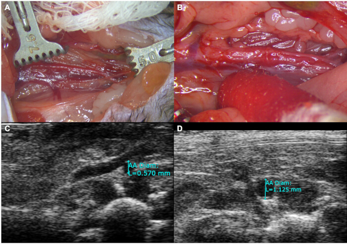 Surgical procedure with arterial dissection and ultrasound imaging showing arterial diameter measurement.