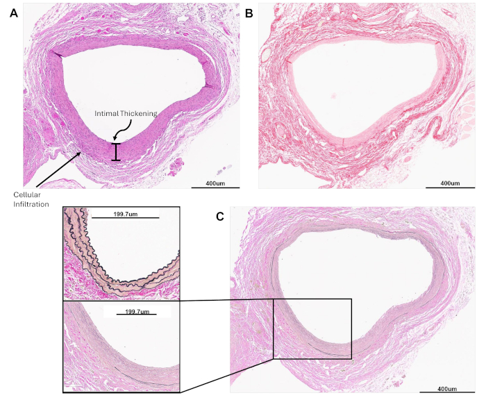 Histology slides showing vascular intimal thickening and cellular infiltration, 400um scale.