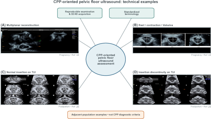 figure-protocol-3 Pelvic floor ultrasound diagram showing multiplanar reconstruction, TUI, muscle assessment.