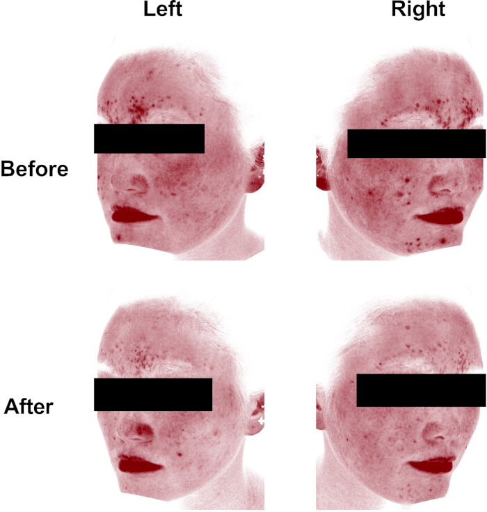 figure-results-2 痤疮治疗效果,皮肤分析前后对比,面部改善情况,对照研究示意图。