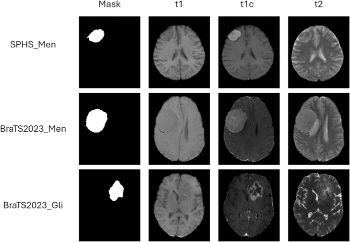 figure-protocol-2 Brain MRI analysis; diagrams showing tumor segmentation masks and MRI sequences t1, t1c, t2.
