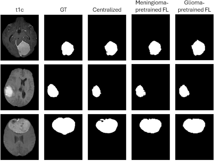 figure-results-1 MRI tumor segmentation comparison; GT, centralized, meningioma/ glioma-pretrained models, brain images.