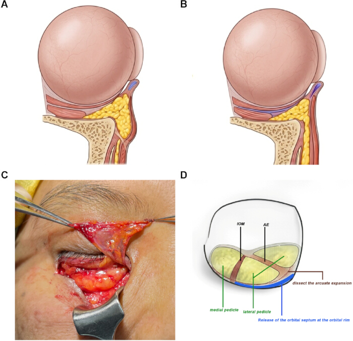 Orbital fat decompression diagram and surgery; anatomical cross-sections, surgical incision.