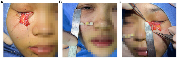 Surgical procedure diagram showing facial reconstruction with ruler measurements and tissue alignment.