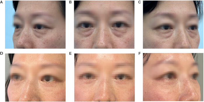 Facial rejuvenation results comparison, pre-treatment and post-treatment, clinical study images.