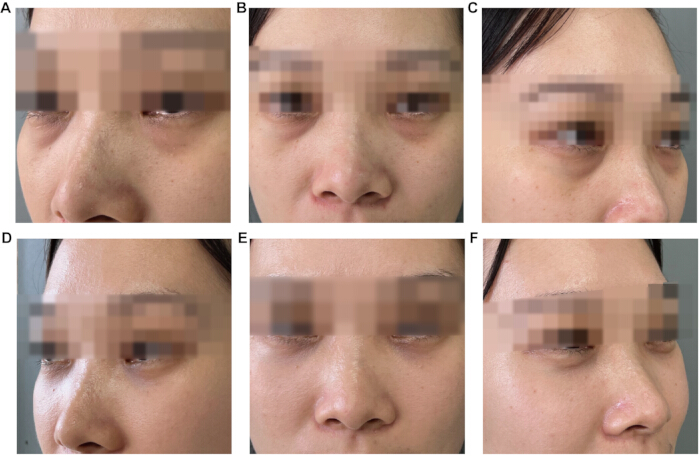 Facial analysis; before-after clinical photos; dermatological study of treatment effects.