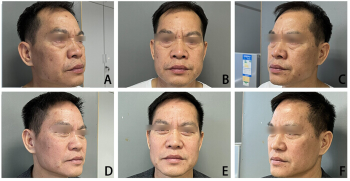 Facial angles diagram for cosmetic procedure results; comparison before/after treatment.