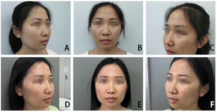 Facial skin treatment result comparison diagram; showcases improvement in pigmentation over time.