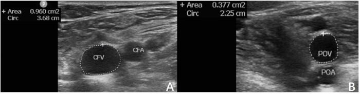 figure-results-2 Ultrasound imaging of vessels; CFV, CFA, POV, POA; shows cross-sectional area, circumference.