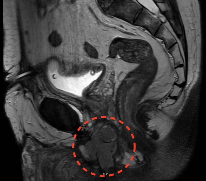 figure-results-1 MRI scan highlighting abdominal area with red circle indicating focal point, medical imaging.