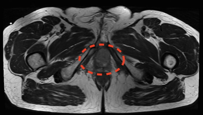 figure-results-2 MRI cross-section displaying pelvic anatomy, illustrating muscle tissues with highlighted abnormal area.