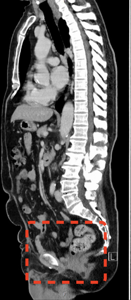 figure-results-3 CT scan diagram highlighting spinal and abdominal structure in sagittal view for medical analysis.