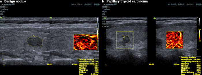 Benign nodule and papillary thyroid carcinoma ultrasound images with density analysis, vessel ratio.