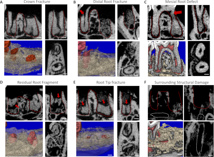 figure-results-3 Dental fracture analysis, CT scan, diagram showing root and crown injuries, structural damage assessment.