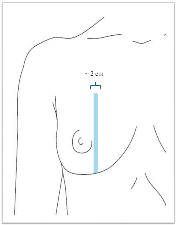 Breast anatomy diagram, measurement from nipple to chest; anatomical study, medical illustration.